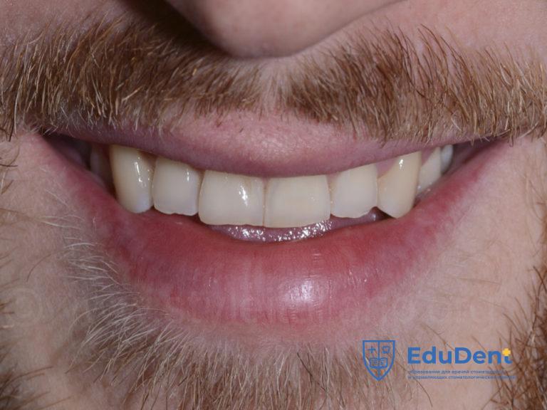 Anterior one layer