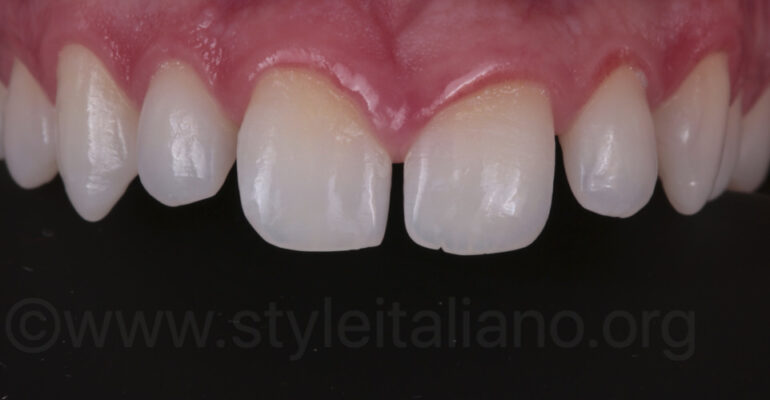 Diastema Closure
