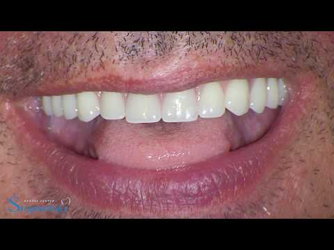 All-on-4-Bar-Supported-Denture-SCHUTZ-IMPLA-CONETOP-1