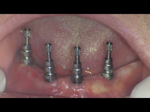 All-on-4x4-Impla-cylindrical-1