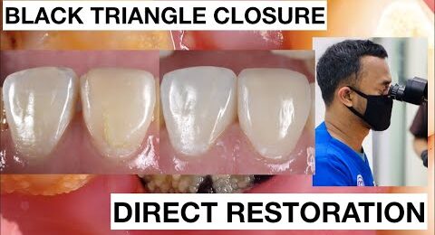 Black-Triangle-Closure-Direct-Bonding-Composite-Restoration-1