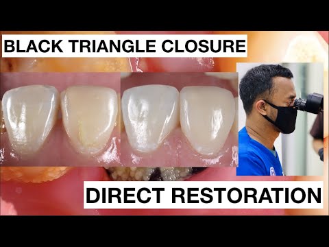 Black-Triangle-Closure-Direct-Bonding-Composite-Restoration-1