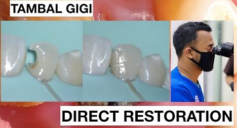 Class-3-with-Direct-Bonding-Composite-Restoration