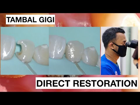 Class-3-with-Direct-Bonding-Composite-Restoration
