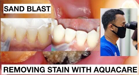 Dental-Cleaning-Stain-With-Aquacare-Easy-No-Pain