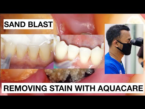 Dental-Cleaning-Stain-With-Aquacare-Easy-No-Pain