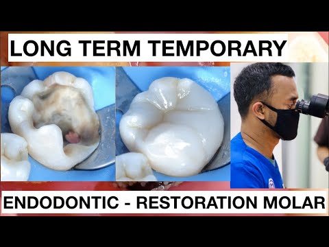 Dental-Endodontic-Direct-Restoration-Long-Term-Temporary-Composite-1