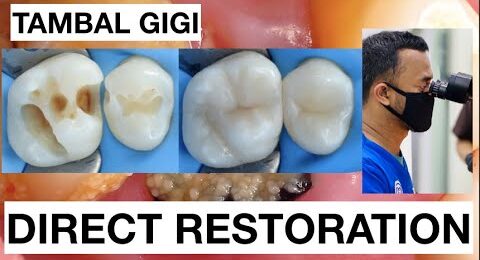 Dental-Filling-Composite-Direct-Restoration-Upper-Molar-Class-II
