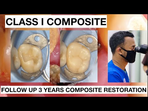 Dental-Filling-Composite-Restoration-After-3-Years-1