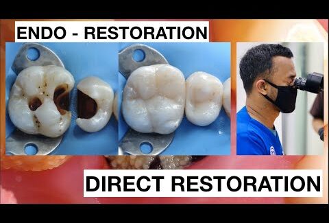 Dental-Filling-Procedure-from-Endodontic-to-Restoration-Composite-1