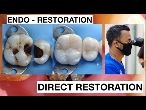 Dental-Filling-Procedure-from-Endodontic-to-Restoration-Composite-1