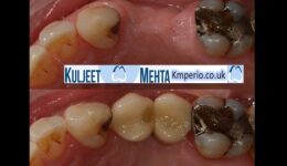Dental-Implants-Screw-Retained-Crowns-.-1