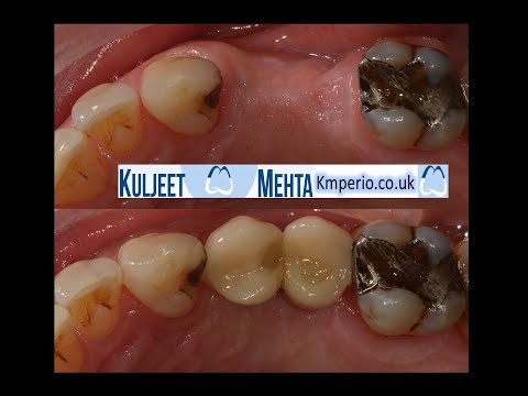Dental-Implants-Screw-Retained-Crowns-.-1