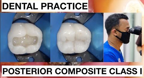 Dental-Practice-Class-I-Composite-Restoration-1