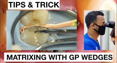 Dental-Tips-and-Tricks-Class-II-Matrixing-With-GP-Wedges-1