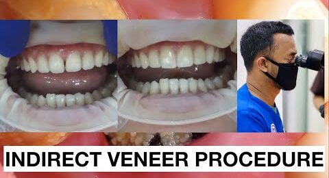 Dental-Veneers-Procedure