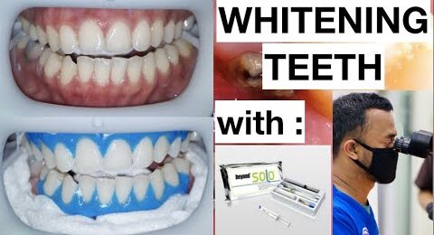 Dental-Whitening-Procedure-Natural-Bright-Smile-with-Beyond-Kit-1