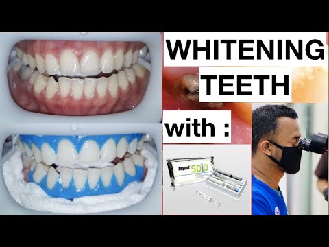 Dental-Whitening-Procedure-Natural-Bright-Smile-with-Beyond-Kit-1