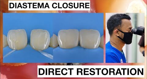 Diastema-Closure-with-Direct-Bonding-Composite-Restoration