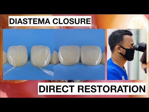 Diastema-Closure-with-Direct-Bonding-Composite-Restoration