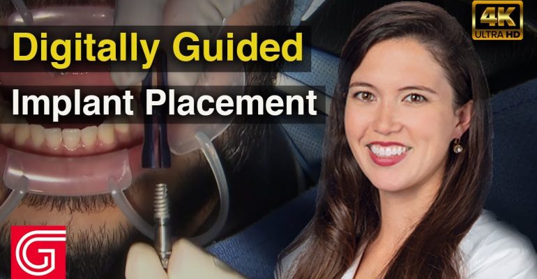 Digitally-Guided-ImplantPlacement-2