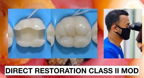 Direct-Restoration-Class-II-Composite