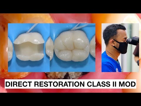 Direct-Restoration-Class-II-Composite
