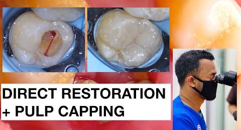 Direct-Restoration-with-Pulp-Expose
