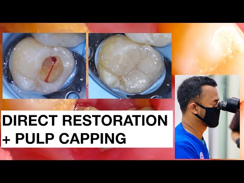 Direct-Restoration-with-Pulp-Expose