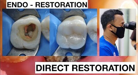 Endo-Resto-Dental-Filling-Composite-Direct-Restoration-Upper-Molar
