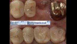 Extraction-Implant-Placement-with-Internal-Sinus-Lift-1
