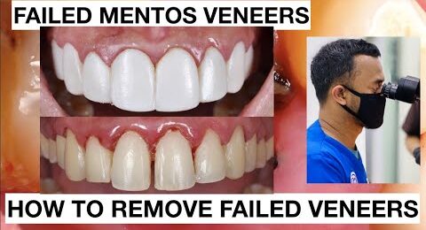 Failed-Toilet-Veneers-how-to-remove-it