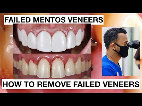 Failed-Toilet-Veneers-how-to-remove-it