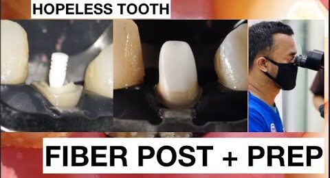 Fiber-Post-Placement-Preparation-Hopeless-Tooth-1
