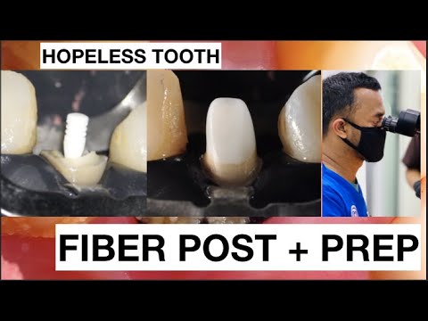 Fiber-Post-Placement-Preparation-Hopeless-Tooth-1