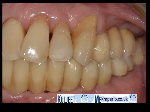 Flapless-Dental-Implant-Crown-and-Bridge-Upper-Jaw-1