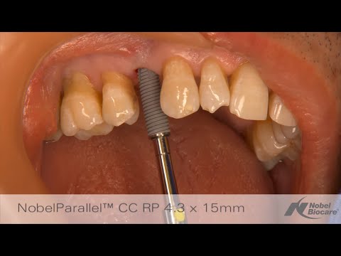 Flapless-high-esthetic-rehabilitation-using-immediate-placement-after-extration-1