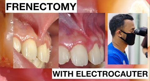Frenectomy-with-Electrocauter-cause-teeth-Gaps-1