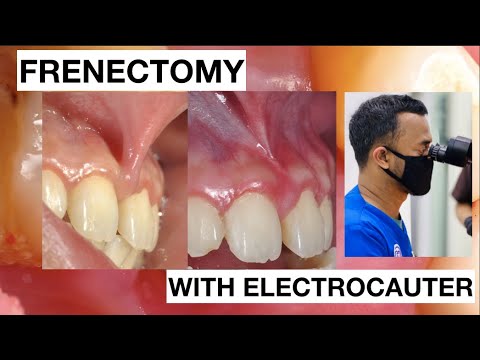 Frenectomy-with-Electrocauter-cause-teeth-Gaps-1