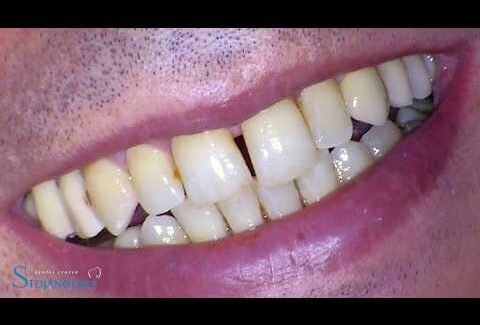 GBR-Sinus-Lift-implantation-Peri-implant-tissue-management-implantoprostetics-1