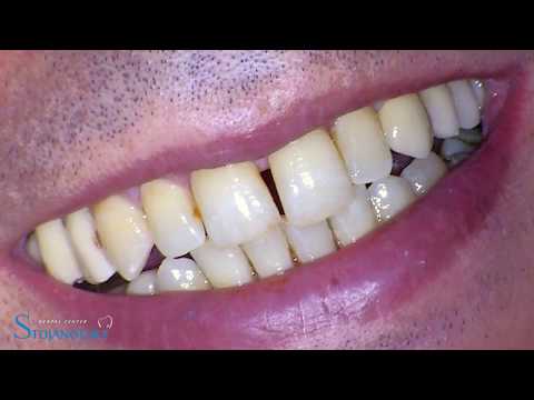 GBR-Sinus-Lift-implantation-Peri-implant-tissue-management-implantoprostetics-1