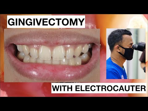Gingivectomy-in-simple-case-Lateral-with-ElectroCautery-1