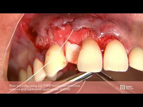 Guided-bone-regeneration-with-simultaneous-implant-placement-1