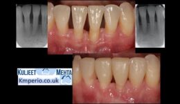 Gum-Recession-Treatment-New-Approach-1