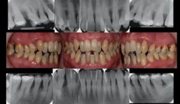Gum-disease-treatment-1