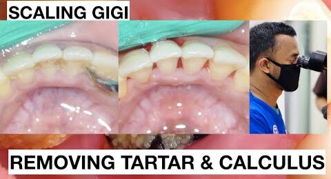 How-Teeth-Are-Cleand-At-Dentist