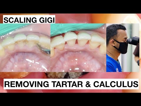 How-Teeth-Are-Cleand-At-Dentist