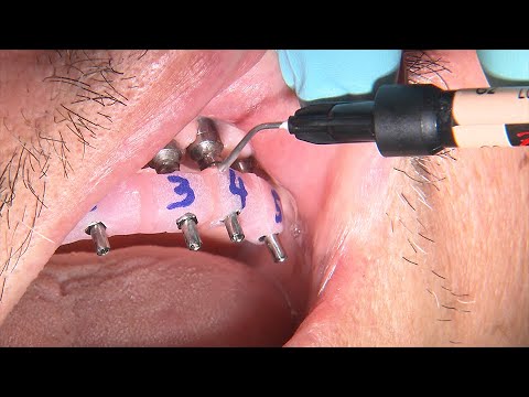 How-to-Fabricate-an-Implant-Verification-Jig-1