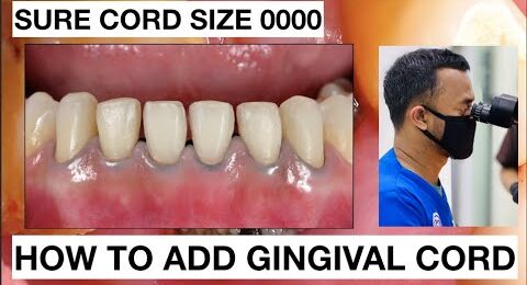 How-to-placement-Gingival-Cord-for-Veneers-Preparation-2
