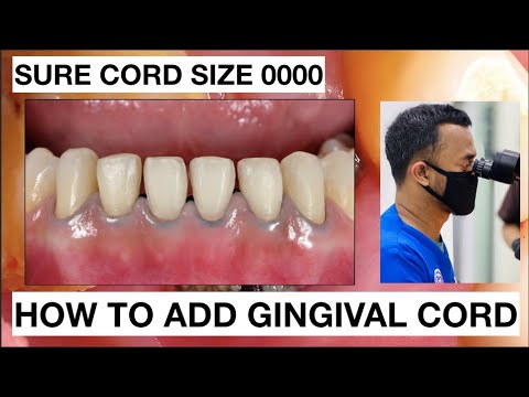How-to-placement-Gingival-Cord-for-Veneers-Preparation-2